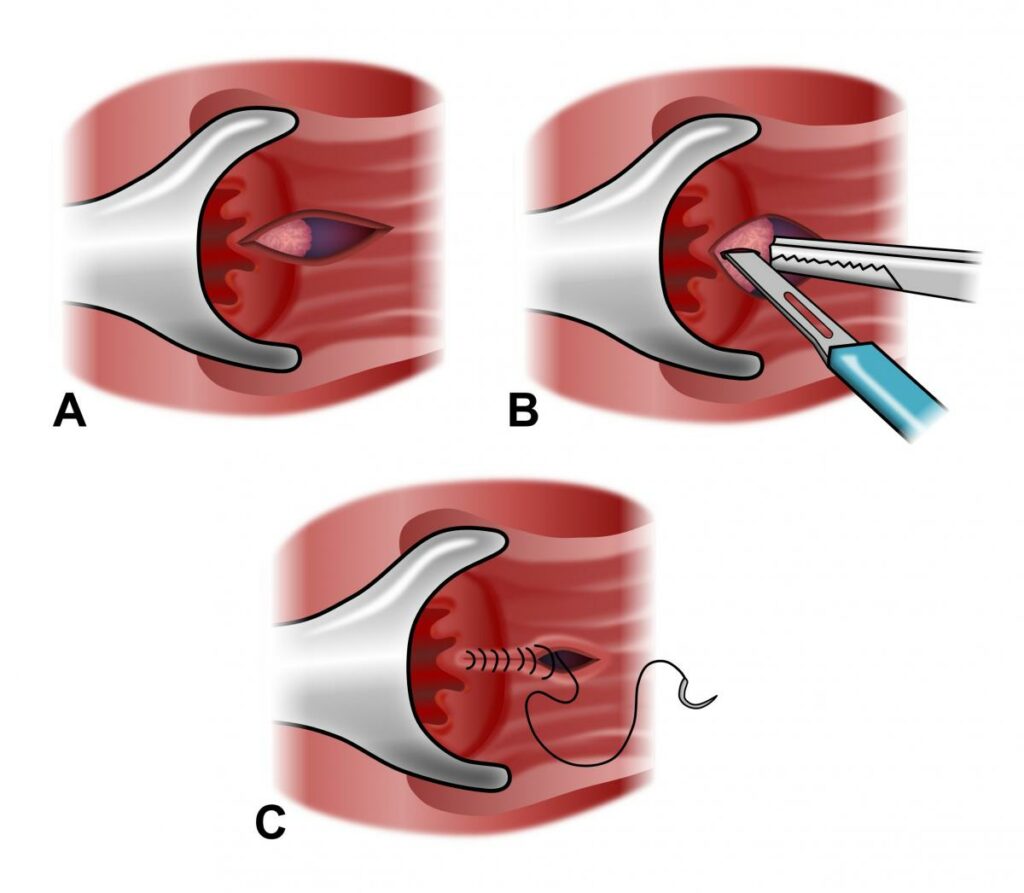 cirurgia de fissura anal